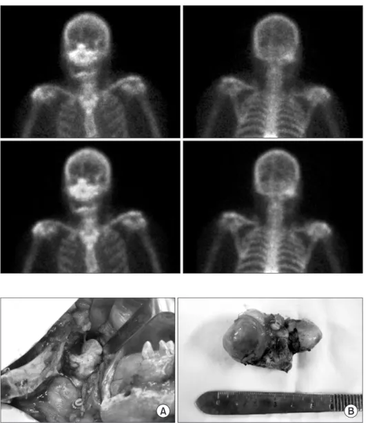 Fig.  3.    99m Tc  bone  scan.  There  is  a  focal hot spot in the right mandibular  condyle
