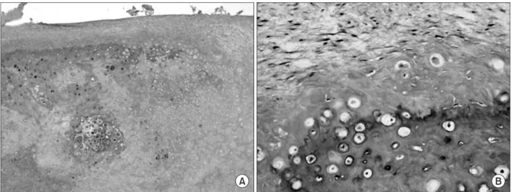 Fig. 5. A. Photomicrograph shows cartilaginous cap and endochondral ossification. B. Magnification of the area of endochondral  ossification