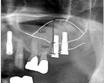 Fig. 1. Augmented bone height (ABH) and residual bone height  (RBH)  were  measured  on  the  IMPAX  system
