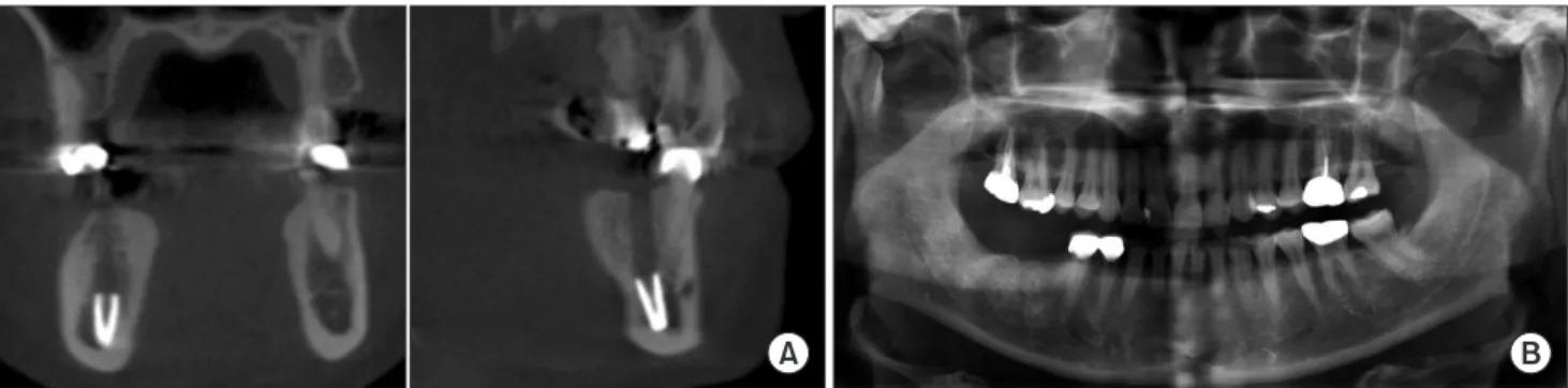 Fig. 1. A. Preoperative coronal (left) and sagittal (right) cone-beam computed tomography showing the displacement of the #46 implant  near the mandibular border of case 1