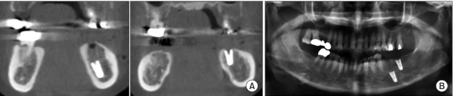 Fig. 3. A. Preoperative cone-beam computed tomography view of the displacement of #36 implant (left) near the mandibular border area  and normal bone state of #37 implant (right) of case 3