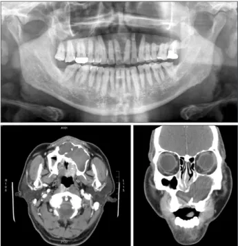 Fig. 1. Preoperative radiologic views of case 1. The panoramic  view  showed  the  large  bone  with  the  destroyed  cystic  lesion  from the anterior maxilla to the entire left side of the maxilla and  maxillary sinus