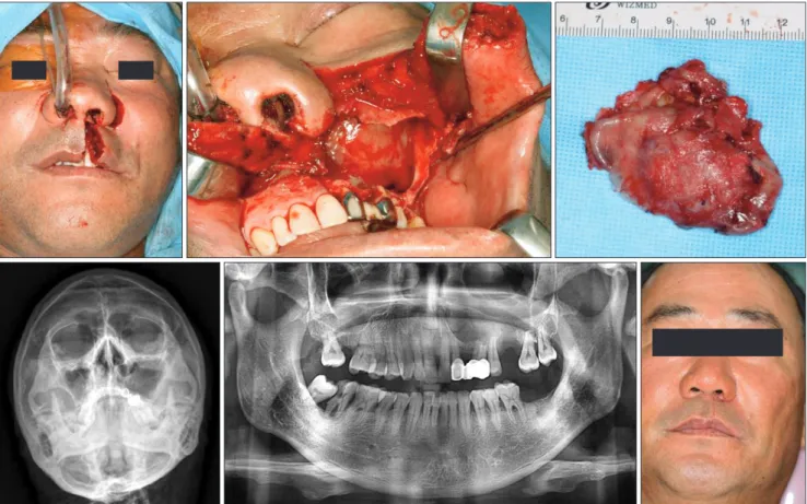 Fig. 4. Intraoperative views, tumor specimen, and postoperative radiograms and clinical view of case 2
