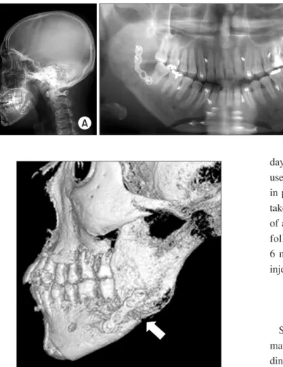 Fig. 4. Third day after botulinum toxin  type  A  injection.  A.  Lateral  view.  B. 