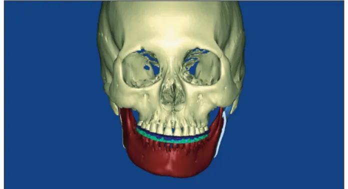 Fig. 2. Digital dental cast (purple and pink) was imported and  integrated onto the computed tomography image in the surgical  simulation software.