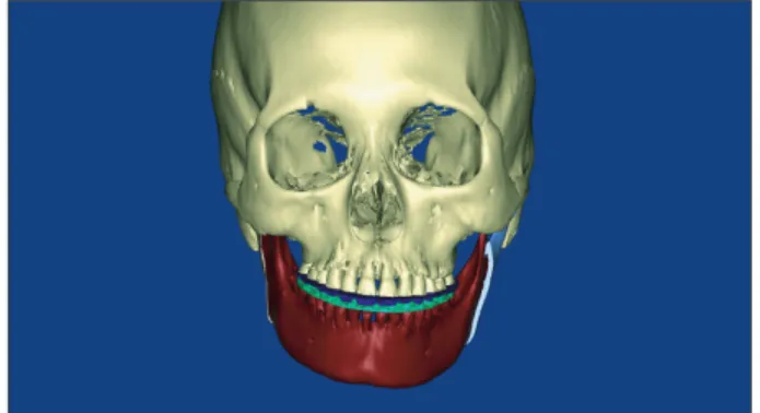 Fig. 2. Digital dental cast (purple and pink) was imported and  integrated onto the computed tomography image in the surgical  simulation software.