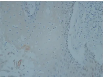 Fig. 3. Epithelial cells showing koilocytosis reacting positively to  human papilloma virus 18 antibody (×400).