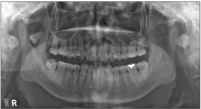 Fig. 1. Panoramic view of ectopic mandibular third molar in the  right ascending ramus of the mandible.