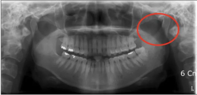 Fig. 4. Panoramic view after the removal of the broken needle. 