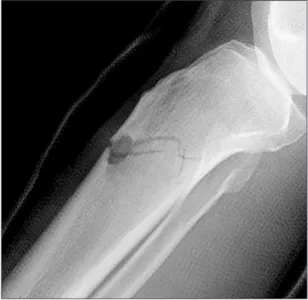 Fig. 3. Case 1, noninvasive reduction of the fractured tibia.
