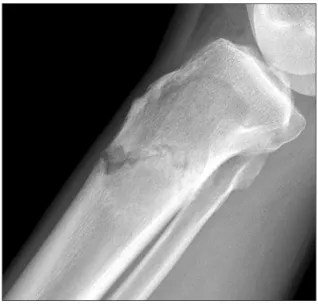 Fig. 7. Case 2, noninvasive reduction of the fractured tibia.