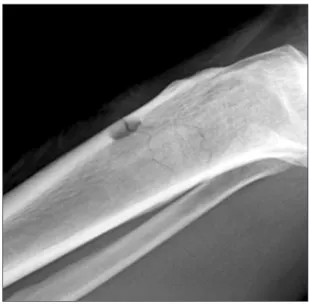 Fig. 11. Case 3, tibial fracture.