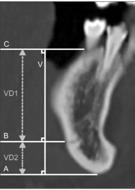 Fig. 1. Reference lines used in measurement on the coronal views  of multi detector computed tomography