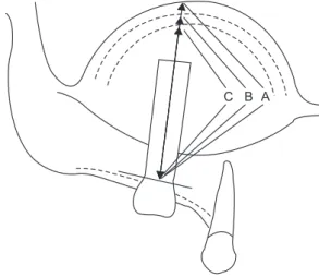 Fig. 1. The measurements for evaluating the amount of bone aug- aug-mentation. (A: measure of the distance between the uppermost  part of bone graft material and the lowermost partof the fixture  threads on the panorama, B: measuring of the amount of bone 