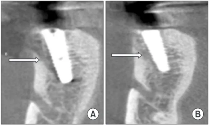 Fig. 6. After 6 months, computed tomography (CT) scan around  buccal wall defect (arrow) showed more radio-opacity than the  initial implantation with auto-tooth bone grafting
