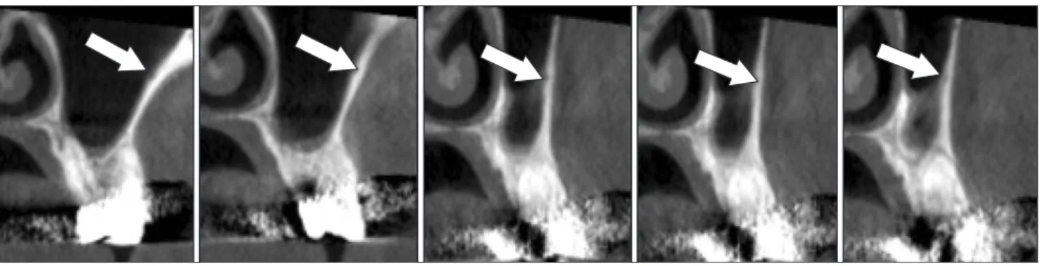 Fig. 4. Continuity of the posterior superior alveolar artery on the computed tomography T image.