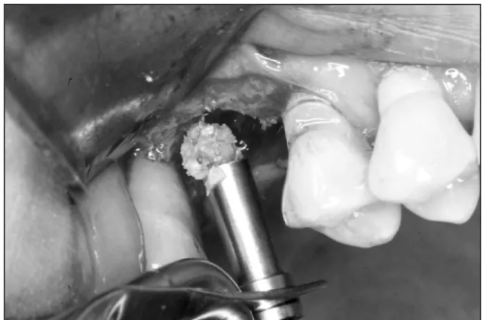 Fig. 2. Bone graft material was inserted under the elevated sinus  membrane using amalgam carrier.