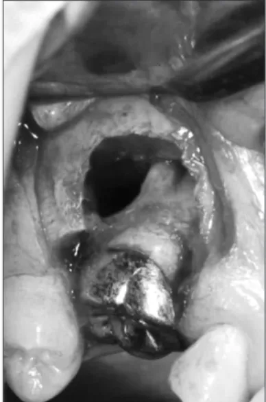 Fig. 5. A piezoelectric device was used to cut the residual fused  tooth-bone segment to preserve sinus membrane integrity.