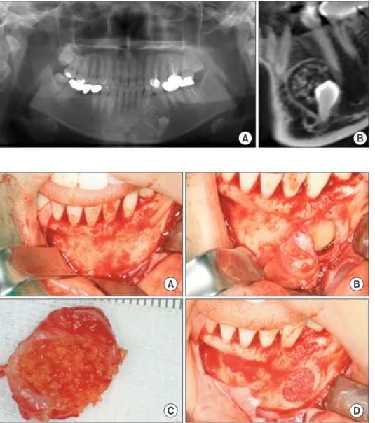 Fig. 1. The radiolucent mass contains  some  agglomerated  radiopaque  materials  around  the  impacted  left  mandibular  first  premolar  (A)  and  Dental CT view (sagittal view) (B)