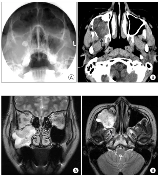Fig. 1. A. Pre-operative Water’s view; 