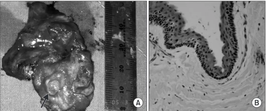 Fig. 3. A. The excised mass with a dis- dis-placed third molar contained (arrow). 