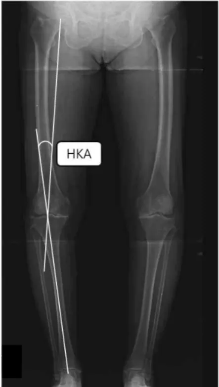 Figure  1.  Negative value (knee varus) hip-knee-ankle angle.는 두 군간 차이가 있을 것이다. 넷째, 수술 전과 수술후 TTA 변화량이 두 군간 차이가 있을 것이다.Ⅱ