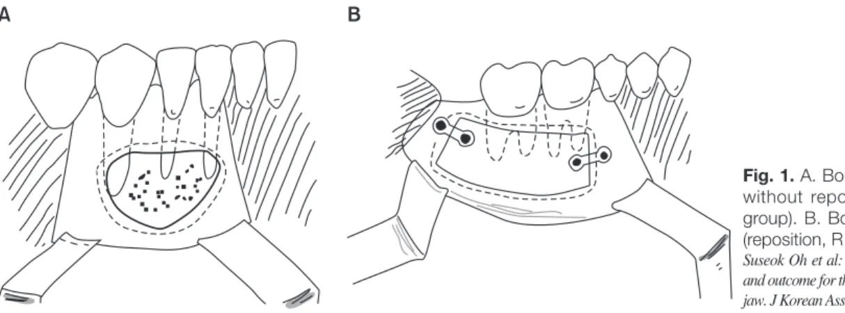 Fig. 1. A. Bony grinding was performed  without  reposition  (no  reposition,  NR  group)