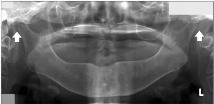 Fig. 4. The postoperative panoramic view revealed bilateral con- con-dy lectomy (arrows)