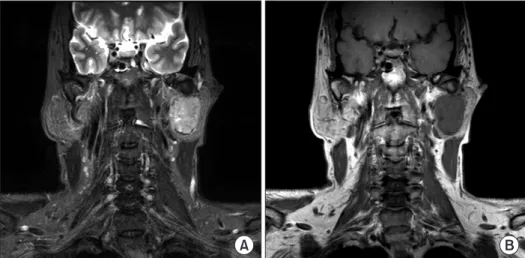 Fig. 2. A. In T1W1 magnetic resonance  imaging,  there  is  a  well-defined  and  non-homogeneously enhanced mass on  the deep portion of left parotid gland