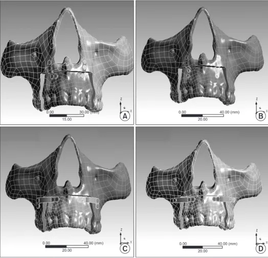 Fig.  1.  Four  types  of  anterior  seg- seg-mental  osteotomy  model  fixed  with  different pattern of plates and screws