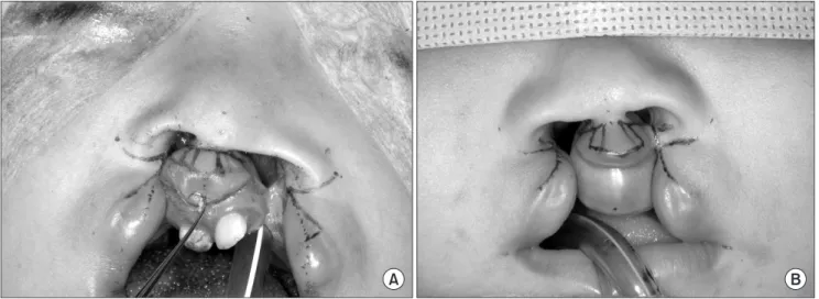 Fig. 5. Dissection of the orbicularis oris muscle and elevation of flap.