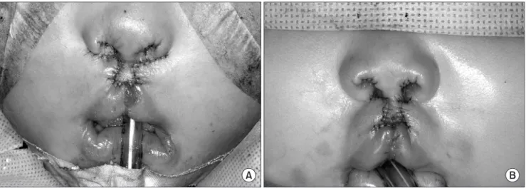 Fig. 8. Frontal view after suturing. A. 18 months child. B. 6 months child. 