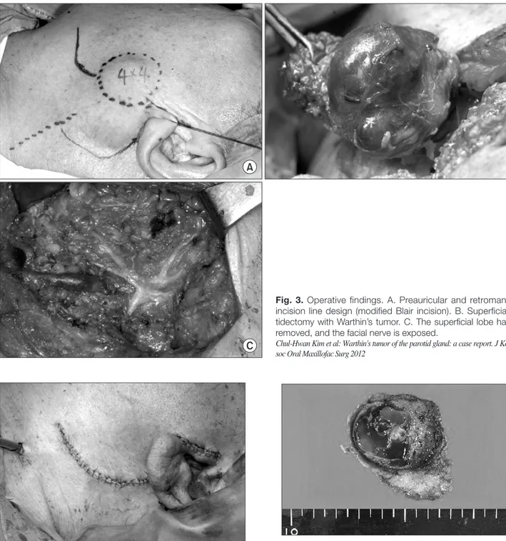 Fig. 3. Operative findings. A. Preauricular and retromandibular  incision line design (modified Blair incision)