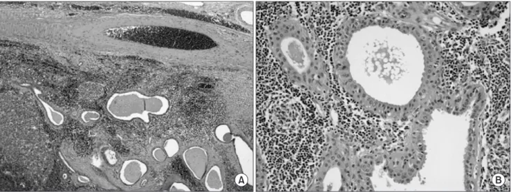 Fig. 6. Microscopic findings. The tumor consists of cystic spaces lined by bilayered oncocytic epithelium and lymphoid stroma (H&amp;E  staining, A: x40, B: x200).