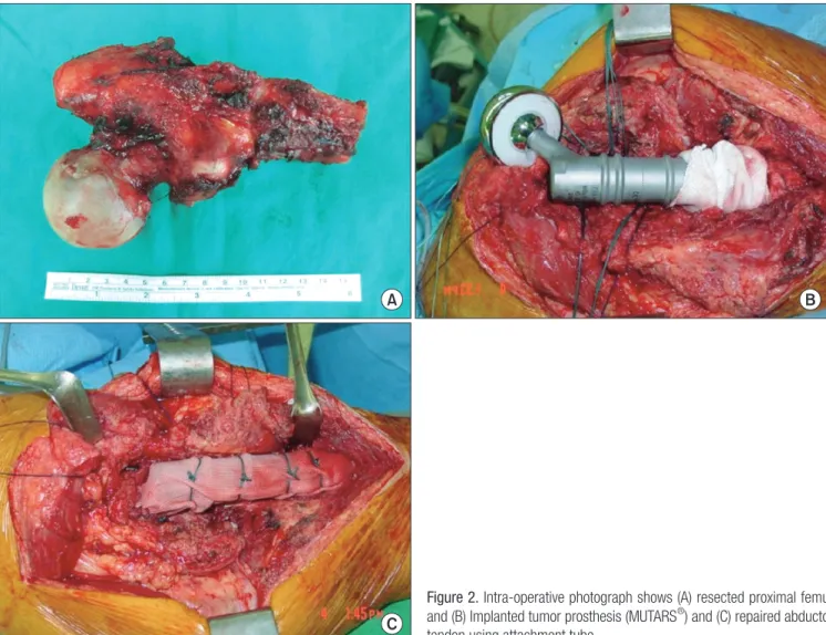 Figure 2. Intra-operative photograph shows (A) resected proximal femur  and (B) Implanted tumor prosthesis (MUTARS ® ) and (C) repaired abductor  tendon using attachment tube