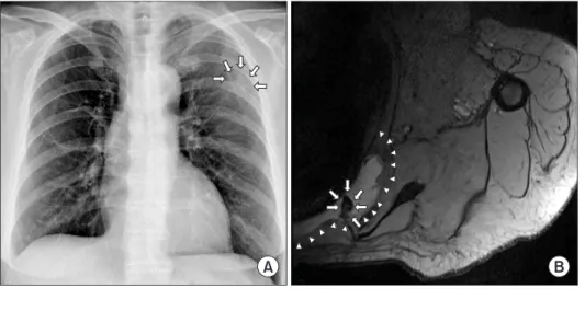 Figure  1.  On  preoperative  x-ray  about  1.2 cm size exophyticbony mass (white  arrow) is noted on the middle part ofthe  left 6 th  rib (A)