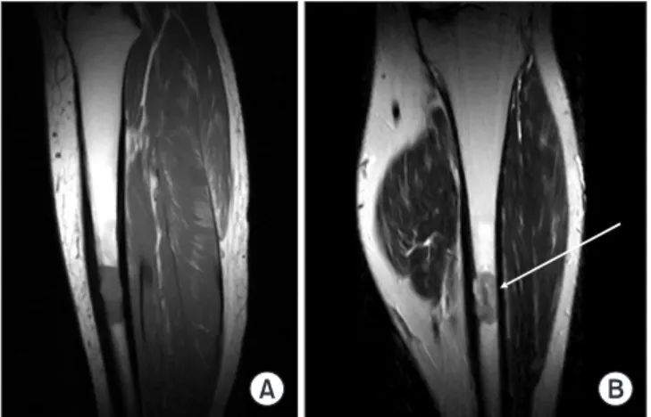 Figure 3. Preoperative bone scan shows  increased uptake of left tibia mid-shaft. 