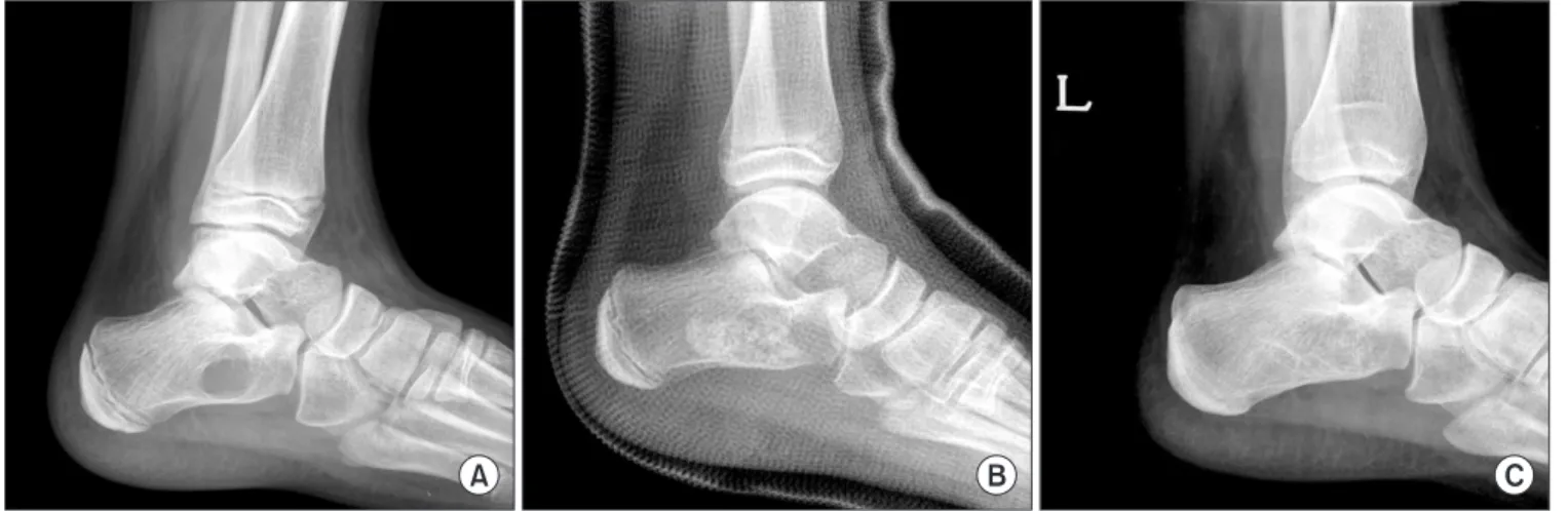 Figure 1. (A) Cystic lesion with well-defined margin in calcaneus was found accidentally after ankle sprain