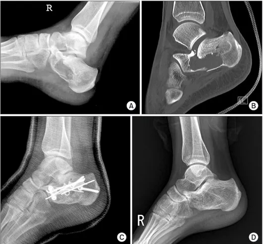 Figure 3. (A) Cystic lesion with pathologic  fracture was found in radiograph after  fall-down