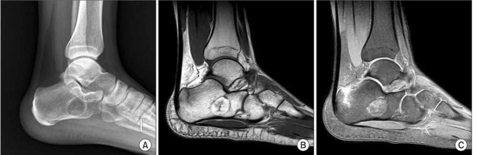 Figure 5. (A) An exophytic osseous mass at plantar surface of calcaneus was found in radiograph