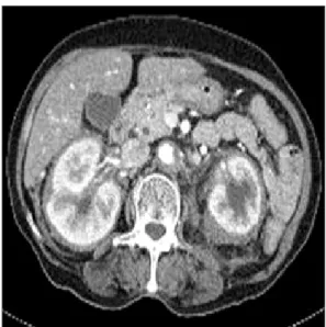 Figure 1. On computed tomography, there are soft tissue invasions  around both kidney.