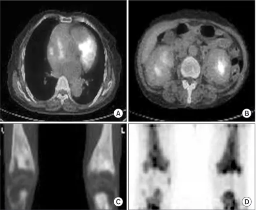 Figure  3.  On  PET  CT,  it  showed  high  metabolic lesions of SUV 4.7 in heart (A),  kidney (B), bilateral distal femoral, and  proximal tibia (C, D).
