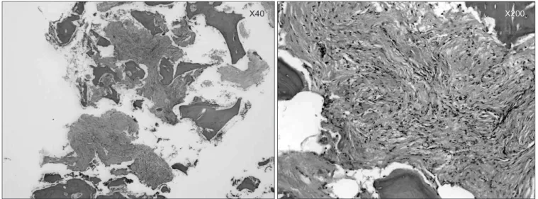 Figure 5. The bone biopsy revealed an intraosseous fibrosis. H &amp; E (Hematoxylin &amp; Eosin) staining.
