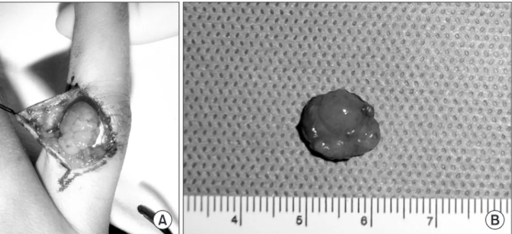 Figure 2. Radiograph shows a round soft tissue lesion on right 4 th proximal  phalanx,  but  neither  bony  erosion  nor  calcification  was  observed.