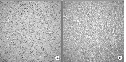 Figure 5. Pathologic findings: (A) Tumor  cells  are  composed  of  intersecting  fascicles  of  well-differentiated  smooth  muscle cells that are characterized by a  spindle shape, eosinophilic cytoplasm and  blunt-ended, cigar-shaped nuclei (×200)