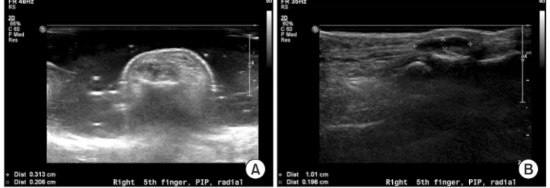 Figure 4. MRI shows a well demarcated  ovoid mass of T1 low to intermediate  and T2 intermediate signal intensity