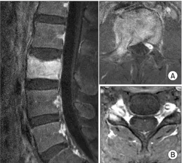 Figure 2. In preoperative computerized tomography scan, axial view  shows osteolytic lesion in vertebral body and right pedicle (A)