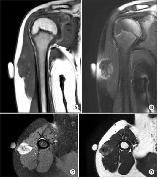 Figure 3. (A) Gross examination reveals an ill-demarcated firm brownish mass. (B) The cut surface is nodular with whitish solid appearance.