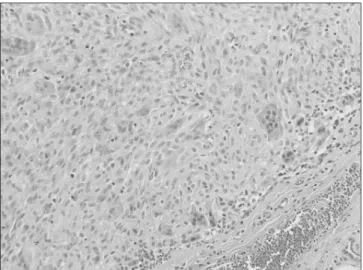 Figure 5. Tumors are composed of multi-nucleated giant cells admixed  with round cells and collagen (H&amp;E, ×200).