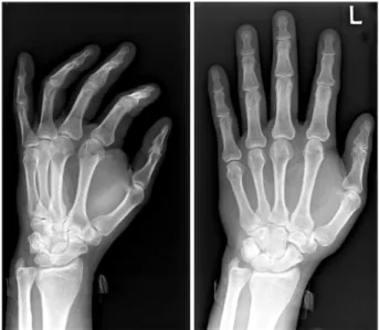 Figure 1. Plain radiographs demonstrate a large mass in the 1st, 2nd  web space. 